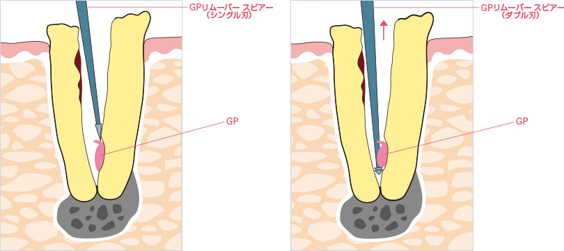 GPの使用イメージ