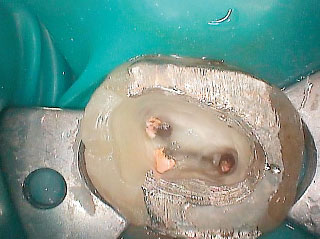 治療開始時の根管内部の画像