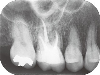 根管治療後1Y後のレントゲン画像