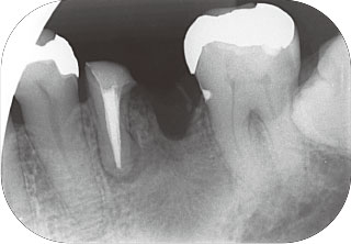 根管充填後のレントゲン画像