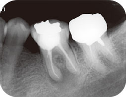下顎左側第一大臼歯のエックス線写真