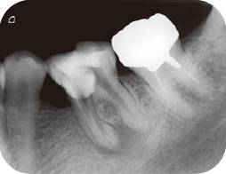 下顎左側第一大臼歯のエックス線写真