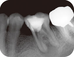 近心根根尖部に、残留していた破折片が除去されたことを確認したエックス線写真