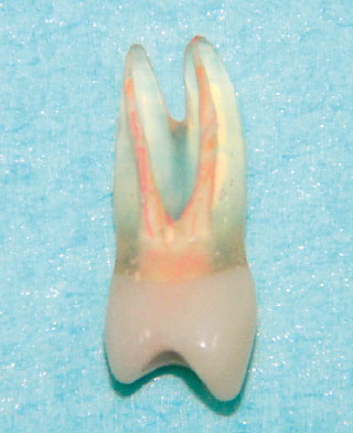 根管充填されている上顎左側第一小臼歯の人工歯の画像