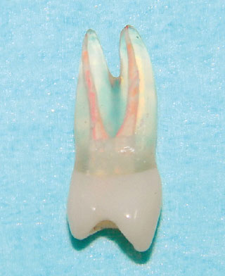 根管口までサージカルバーによって除去された人工歯の画像