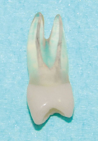 根尖部までほぼ除去された人工歯の画像