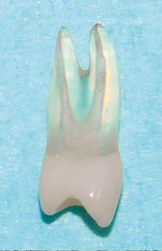 根管治療を終了した人工歯の画像