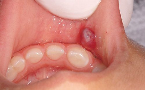 4歳女児、口唇部、粘液嚢胞の写真