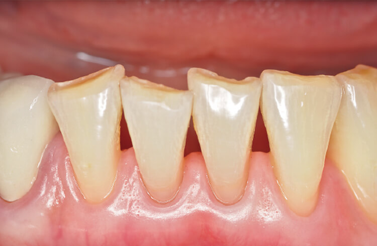 歯頸部楔状欠損症例。