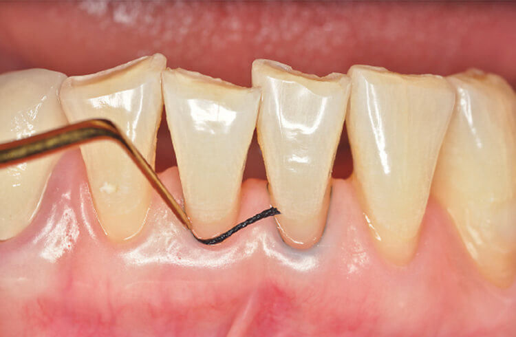 歯肉圧排コードをポケットに挿入することで、欠損部を明視化するとともに歯肉溝浸出液の洩出を防止する。