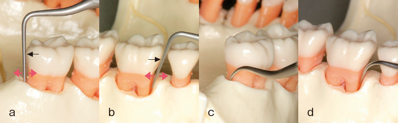 ぺリオチップP2の効果的使用法の写真