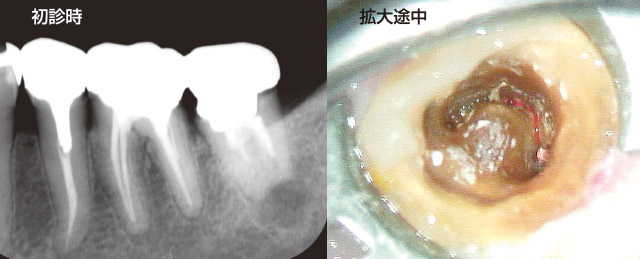 ソルフィーFによる樋状根の感染根管治療の写真1