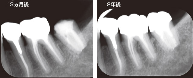 ソルフィーFによる樋状根の感染根管治療の写真2