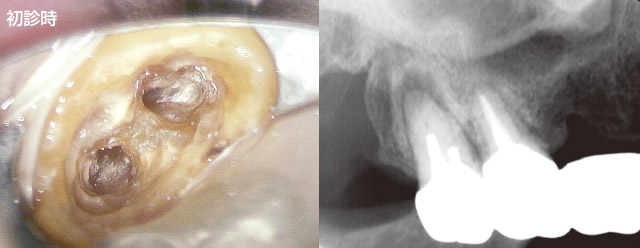 2根管が交通している症例のソルフィーFによる感染根管治療の写真1