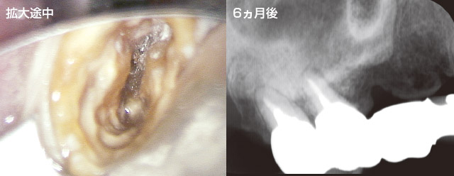 2根管が交通している症例のソルフィーFによる感染根管治療の写真2
