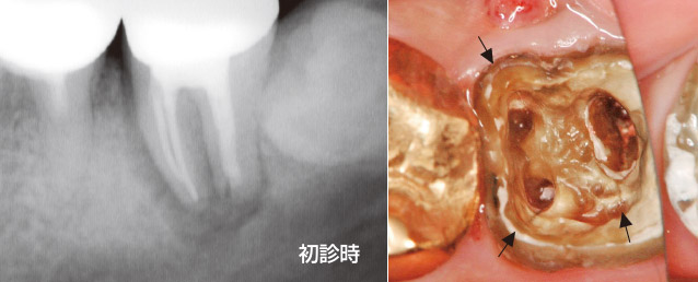 根尖性歯根破折の口腔内接着症例の写真1