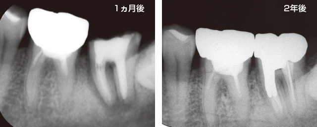 根尖性歯根破折の口腔内接着症例の写真2