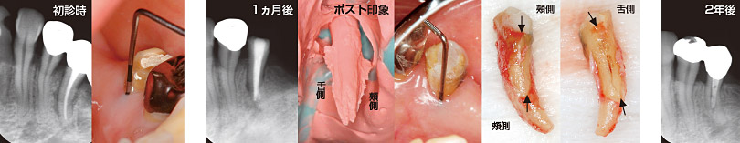 口腔内接着後に再植した症例写真