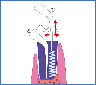 歯肉縁下でのチップの動かし方の図