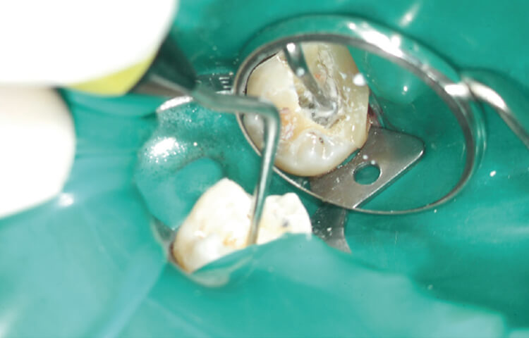 歯冠側のガッタパーチャをコンデンサーにて加圧する。