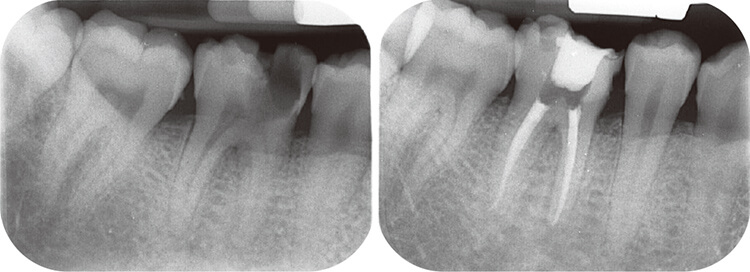 術前のＸ線像（左）と術後のＸ線像（右）。