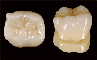 最終補綴物正面観、咬合面観の写真