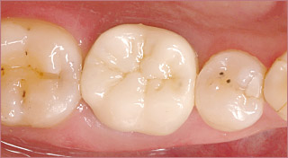 最終補綴物装着時咬合面観の写真