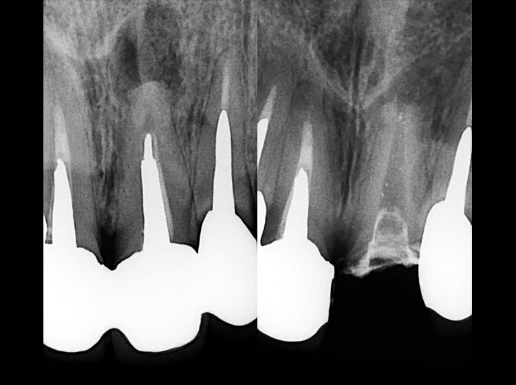 メタルコア除去後根尖病巣の改善が認められる。