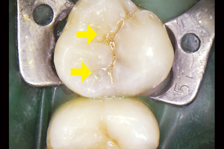近心側に歯質の変色が見られた。また、中心窩もカリエスに罹患している可能性がある。
