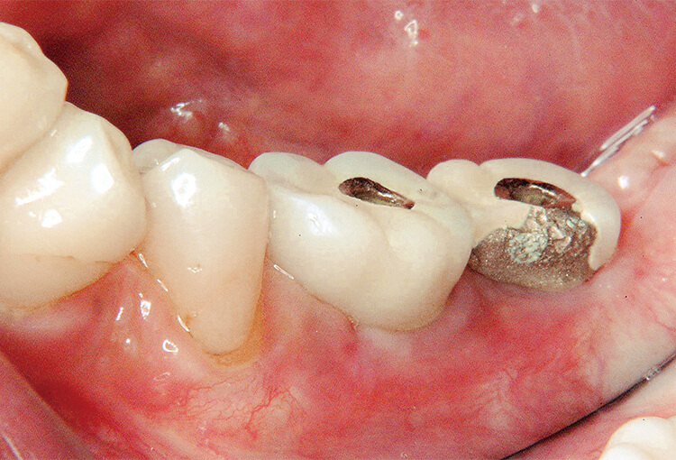 48歳 女性、左側下顎臼歯部インプラント上部構造破損症例。
