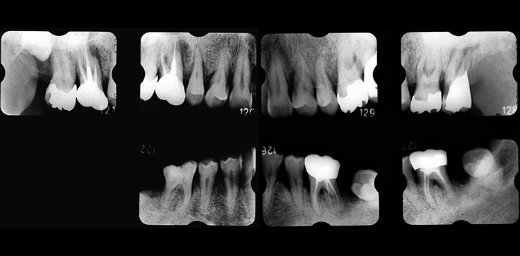 初診時のデンタルX線写真。水平的骨吸収に加え、多数の原因不明の垂直的骨吸収を認める。