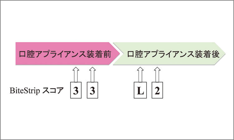 口腔アプライアンス装着前後のBiteStripスコア。アプライアンス装着によりブラキシズム頻度が減少したことが分かる。