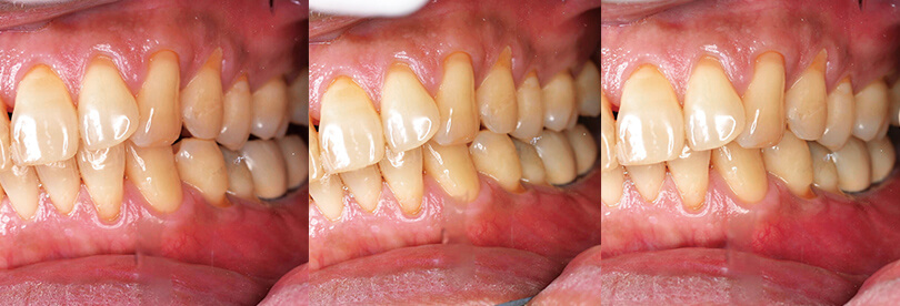 写真左から、安静時、早期接触時、咬合時の口腔内写真。咬合時に、上顎左側第一小臼歯部の早期接触ならびに咬合時の同歯の偏位を認めた。