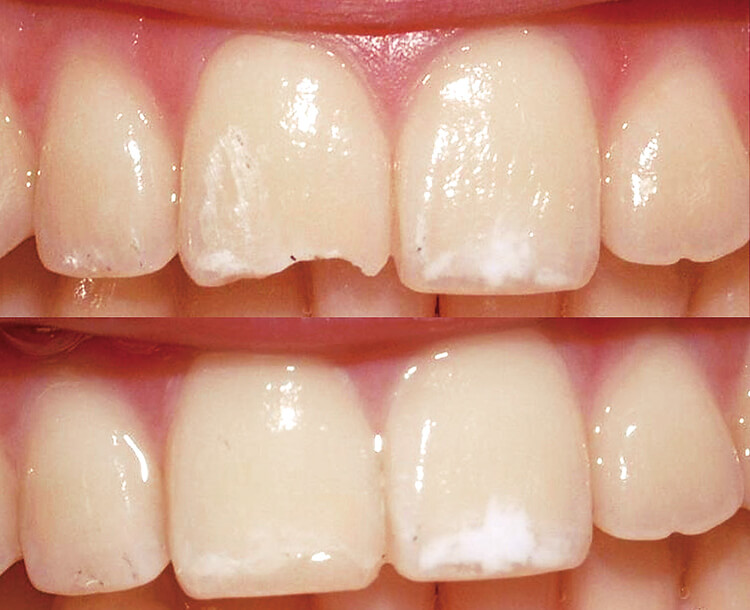 外傷による前歯の切縁のわずかな破折を、高い予知性をもって修復できる。