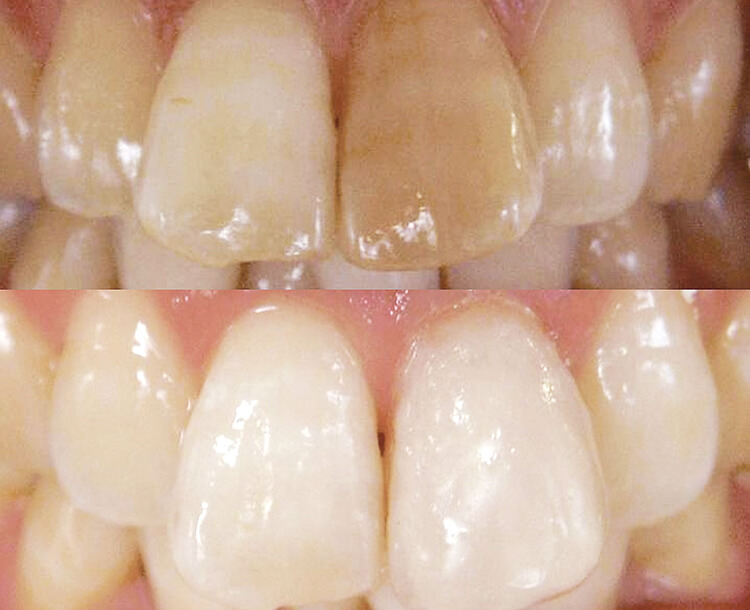 左上1の変色にボンドフィルSBを被覆充填して、審美性を回復した。歯頸部には「サービカル」、中央部は「ミディアム」、切端部は「ライト」を使用した。