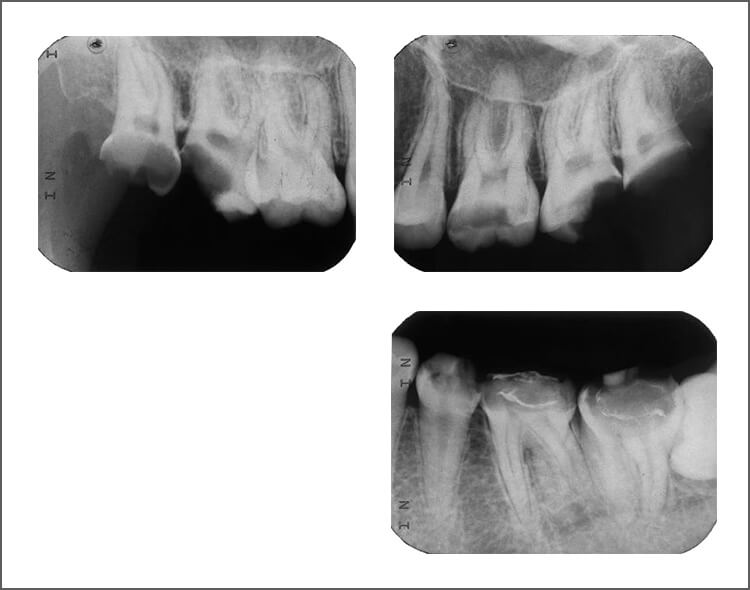 右上7，8、左上7，8、左下6，7は抜髄や抜歯も致し方ないと考えられる深いカリエスであるが、抜髄も抜歯も行わない治療方針とした。