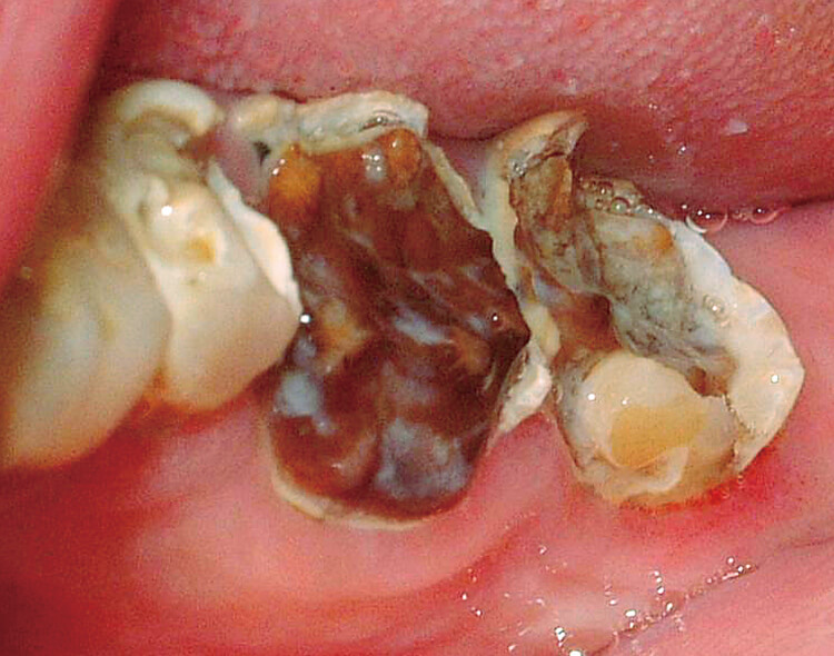 歯冠が崩壊して大量の軟化象牙質の認められる左下6，7。