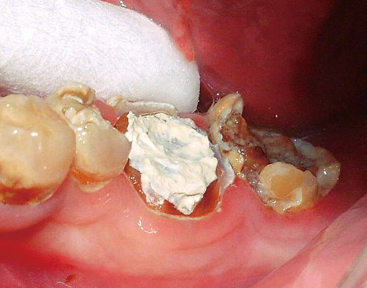 左下6の軟化象牙質に可及的に広く、銅イオンによる殺菌作用を有するセメントを塗布した。