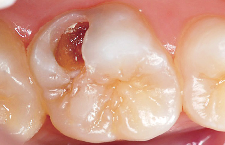 図5-1　上顎第一大臼歯う蝕