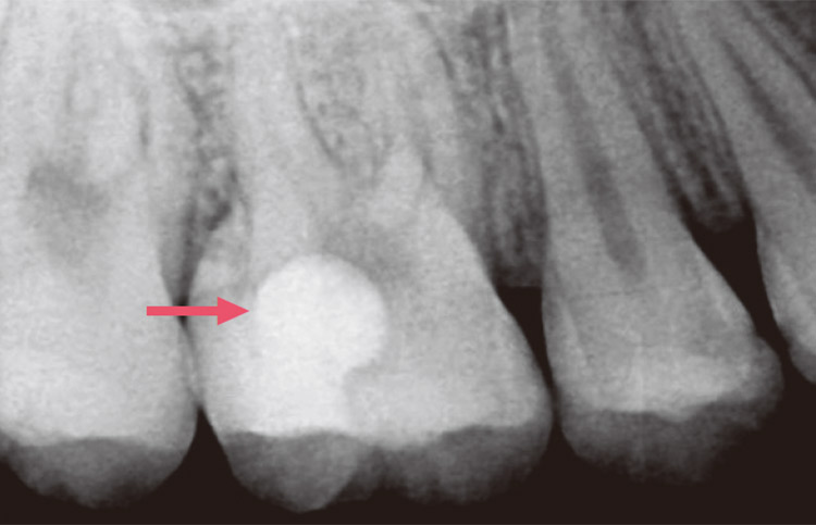 図5-8　X線写真　充填後