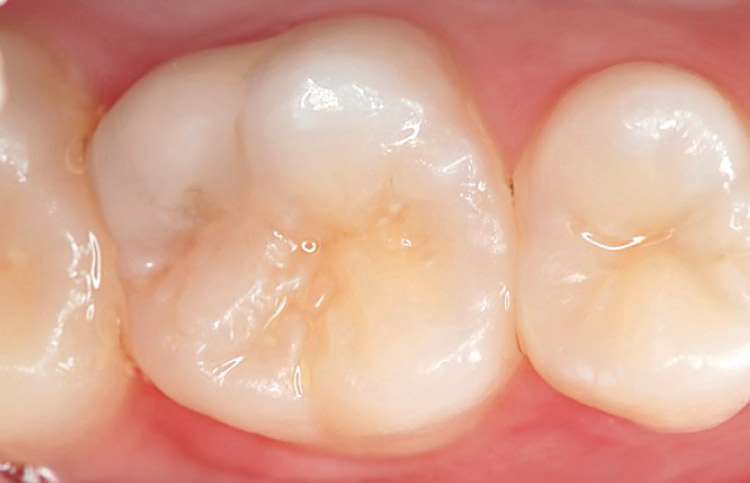 図5-9　充填後　3ヵ月