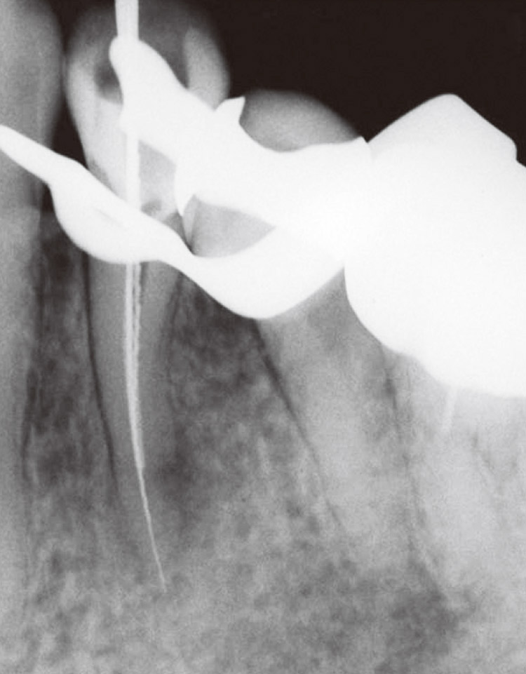図10　ファイル試適時のX線写真。頰舌的に2根管を認める。