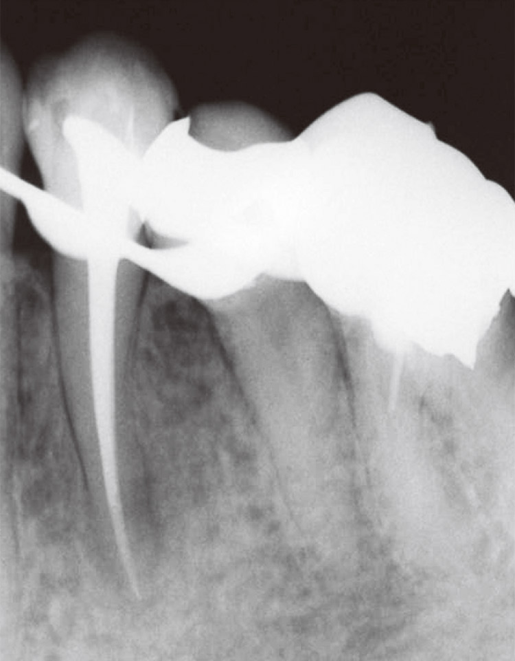 図11　メタシールSoftを用いて側方加圧根管充填を完了した。すでに根尖病変の縮小傾向が認められる。