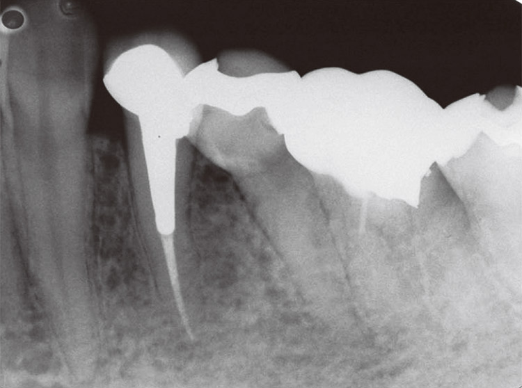 図12　根管充填後3ヵ月半の予後観察では、根尖病変は消退し良好な治癒経過を示している。