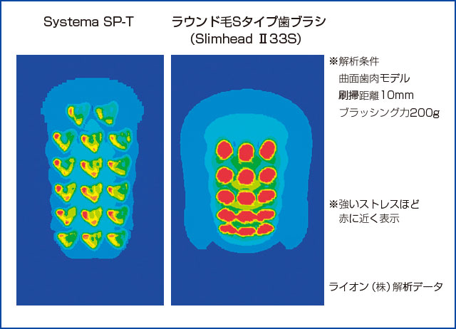 有限要素法解析による歯肉へのストレス比較図