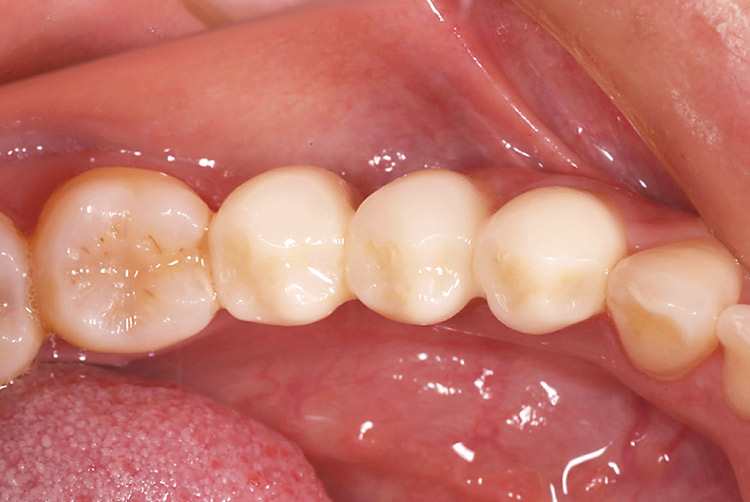図6　術後の状態。メタルフリーのブリッジが装着され、患者の満足を得ることができた。