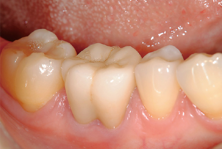 図12　若干色調が明るめではあるが、自然光における状態では大きく開口した状態で患者の満足が得られた。なおかつ強度面でも安心できる材料である。