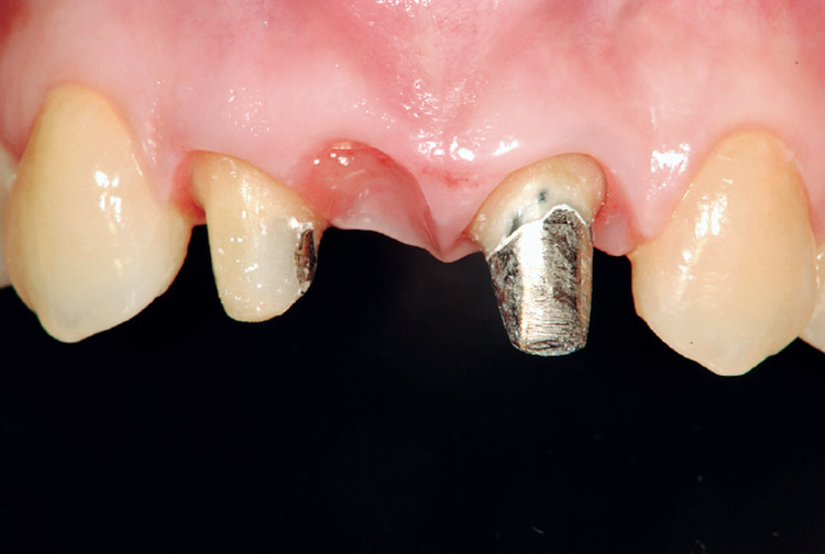 図3　様々なテクニックを使用し、何とか歯頸線の整合性が得られた。プロビジョナルのサブジンジバルカントゥアを調整後の状態。