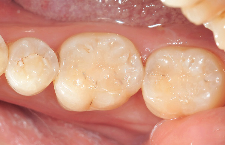 図12-1　咬合調整と研磨を行った術後の状態（咬合面観）。