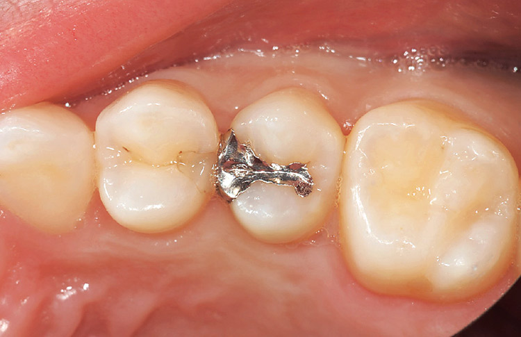 図13　上顎第二小臼歯にメタルインレーが装着されているが、X線像にて二次う蝕がみとめられた。もともと空隙があり食片圧入を前医院にてインレーで治療したとのことであった。